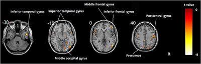 Modulation of Brain Activity and Functional Connectivity by Acupuncture Combined With Donepezil on Mild-to-Moderate Alzheimer's Disease: A Neuroimaging Pilot Study